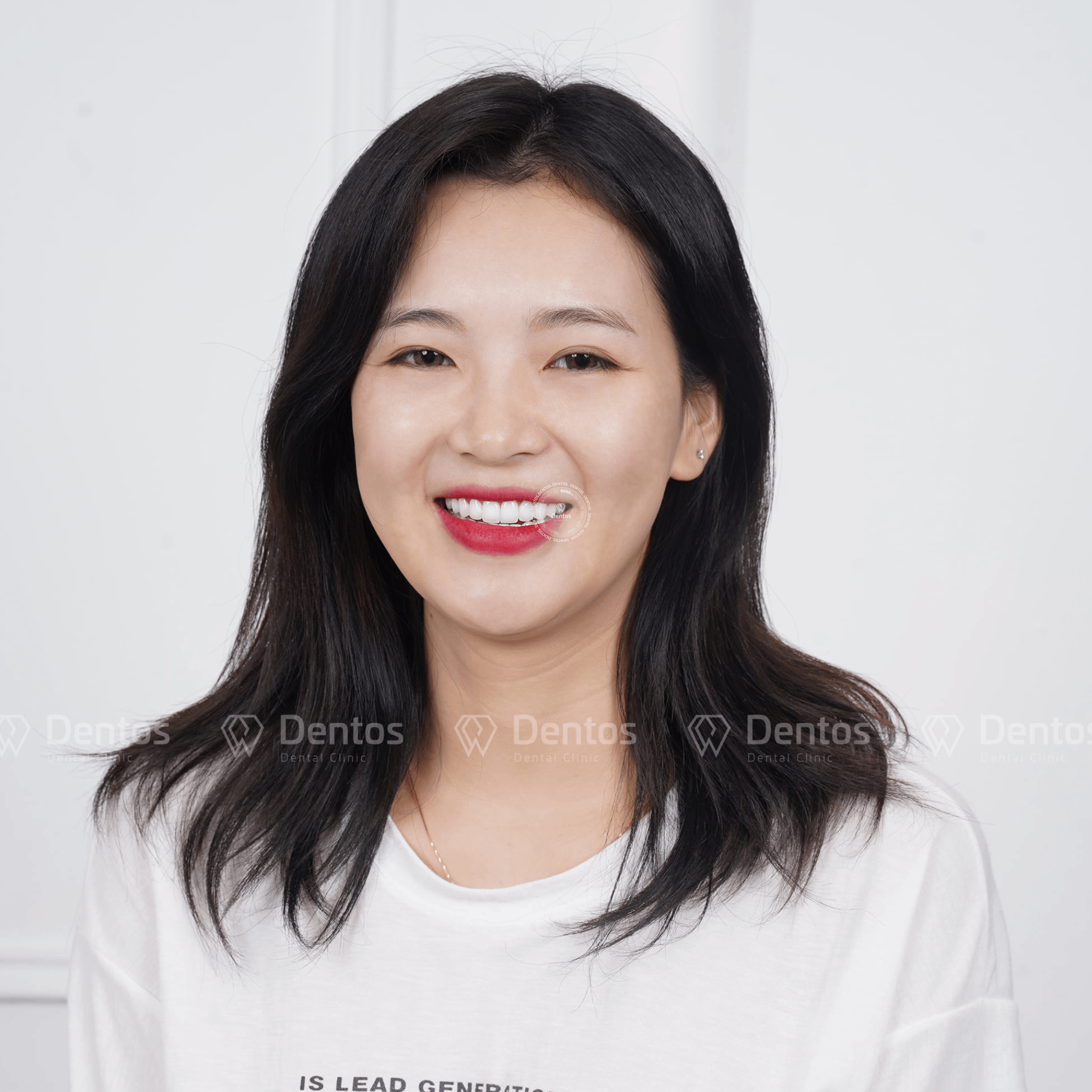 Răng sứ DDBio mang lại hiệu ứng màu sắc trắng tươi rạng rỡ